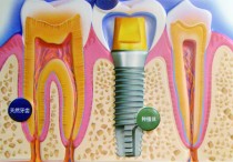 20如果大牙掉了种植咋是什么 牙齿掉了一颗，医生建议种植牙，请问人工种植牙到底是什么啊？