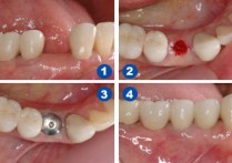 种植牙有什么危害 有人做过种植牙吗?种植牙有什么坏处?