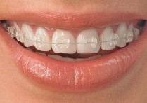 矫正磨牙的平时注意什么 做牙齿矫正有什么注意事项呢？
