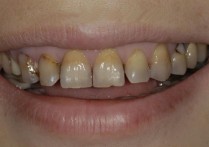 四环素牙是什么 最严重的四环素牙图片
