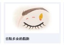 做三点定位双眼皮注意什么 刚做的韩式三点定位双眼皮，已经是第五天了，眼睛一直肿着，有什么办法消肿？
