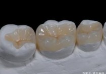 堵牙的物质是什么 补牙用的银白色物质是什么