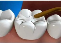 什么情况才补牙 在什么情况下需要补牙，补牙需要多久？