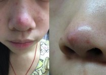 鼻子长痘痘是什么原因 鼻子周围老是长痘痘，是什么原因？该怎么办？