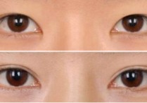定位和埋线有什么区别 韩式无痕双眼皮是不是埋线