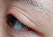 眼袋浮肿是什么原因 下眼袋红肿