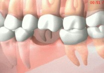 大牙缺失有什么影响 少了颗大牙有影响吗？